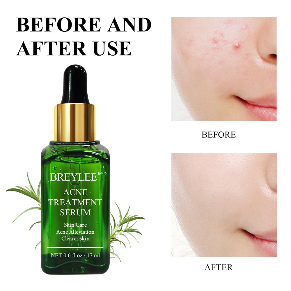 Breylee Acne Treatment Serum 17ml bottle – acne control and clear skin formula with tea tree oil